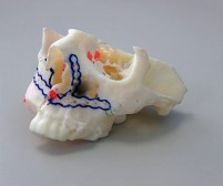 Ziekenhuis verandert mond-, kaak- en gezichtschirurgie met 3D-print